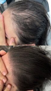 اگزوزوم تراپی برای مو