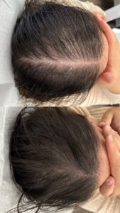 اگزوزوم تراپی مو عظیمیه کرج