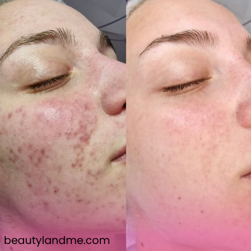 ژل هیدرودرمی فیشیال